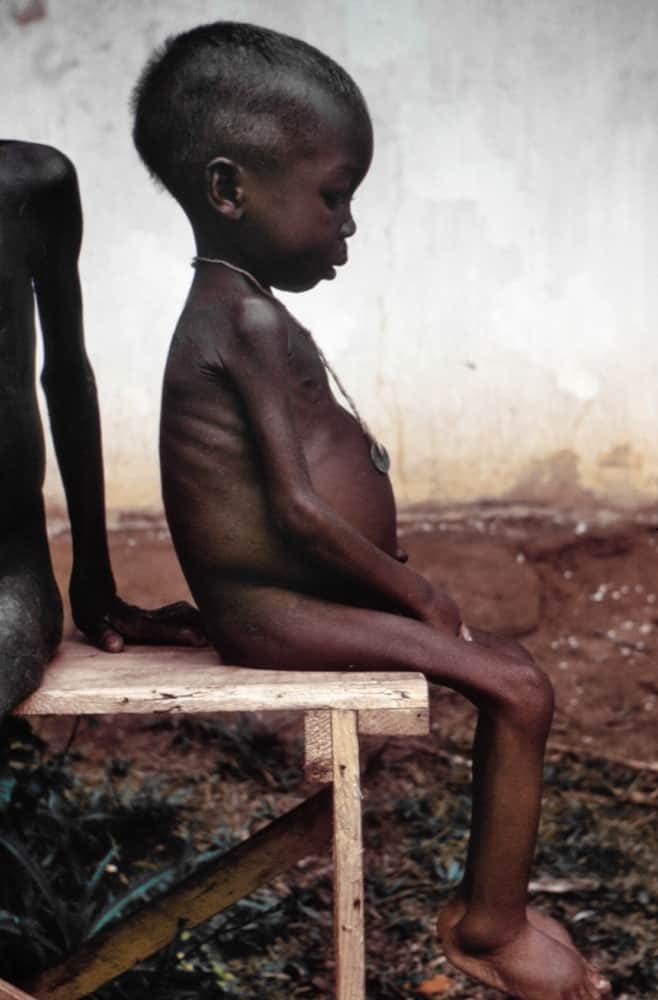 Zimbabweans on the brink of deadly malnutrition
