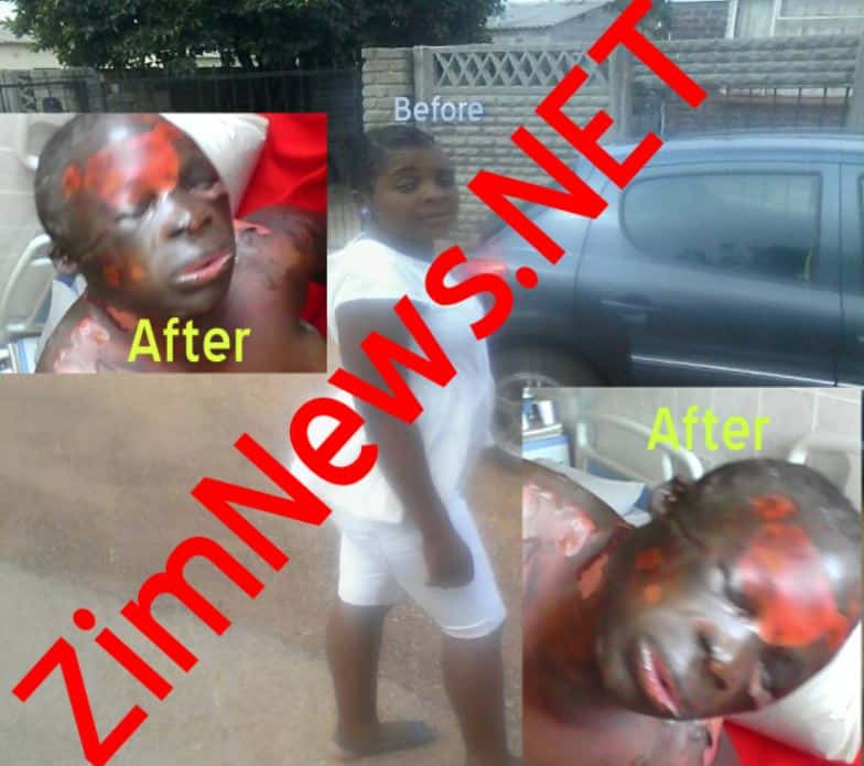 DISTURBING PICTURES: Gweru man burns cheating girlfriend with petrol