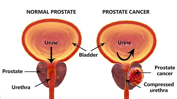 What are the warning signs for prostate cancer?