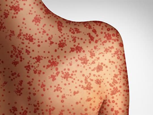 Measles Outbreak Kills 14 Children In Manicaland