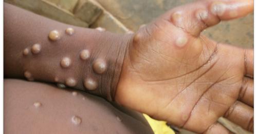 LATEST: Monkeypox detected in South Africa