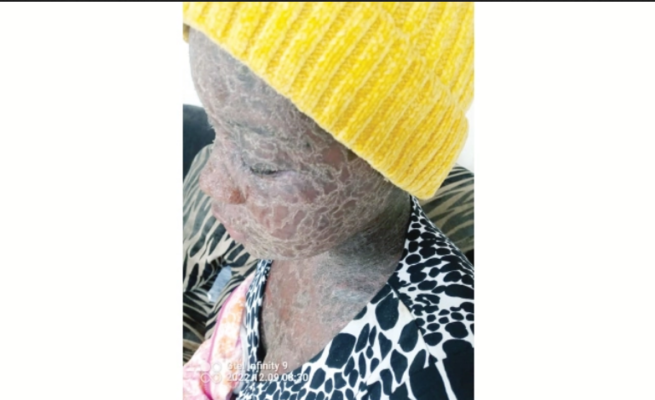 Rusape girl(17) develops rare skin disease, BIG “snake” blamed